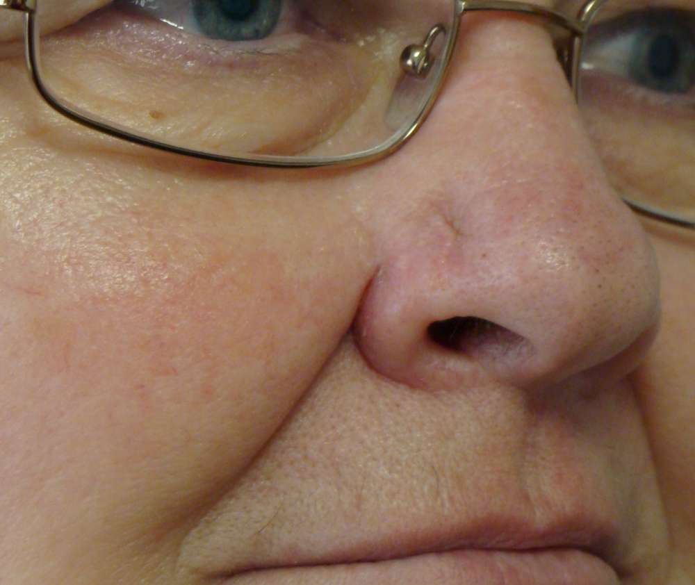 Basal cell carcinoma of the nose